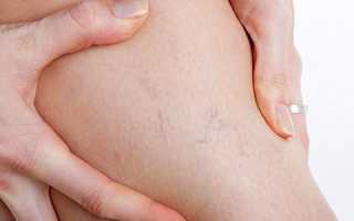 Что делать, если отекают ноги после родов, как решить проблему