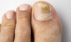 Какие эффективные народные рецепты существуют для лечения грибка ногтей?