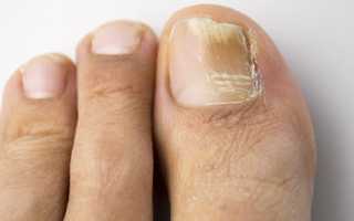 Какие эффективные народные рецепты существуют для лечения грибка ногтей?