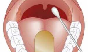 Мазок из горла на стрептококк