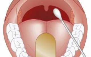 Мазок из горла на стрептококк