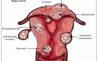 Какие противозачаточные таблетки при миоме матки рекомендуется принимать?