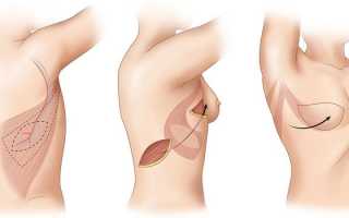 Мастэктомия — показания к удалению груди, подготовка, техника проведения операции и реабилитационный период