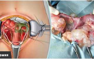 Суть лапаротомии матки и особенности восстановительного периода