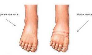 Отёки при беременности