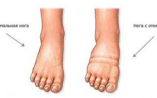 Отёки при беременности