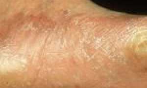 Противогрибковый препарат широкого спектра действия — Тербикс