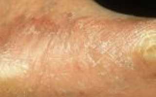 Противогрибковый препарат широкого спектра действия — Тербикс