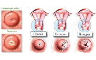 Атипия шейки матки: понятие, симптомы, диагностика и лечение