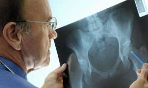 Мраморная болезнь — причины и симптомы у детей или взрослых, диагностика, методы лечения