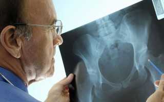 Мраморная болезнь — причины и симптомы у детей или взрослых, диагностика, методы лечения