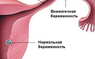 Есть ли шанс родить при внематочной беременности, возможна ли миграция трофобласта в матку?