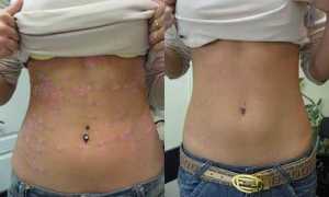 Лечебные свойства солидола при псориазе