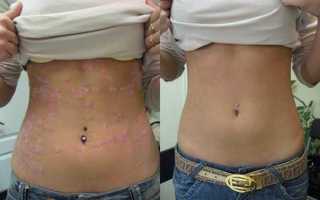 Лечебные свойства солидола при псориазе