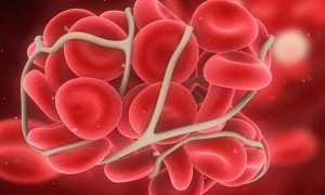 Что такое гемофилия — определение, признаки и причины заболевания, диагностика и способы лечения