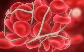 Что такое гемофилия — определение, признаки и причины заболевания, диагностика и способы лечения