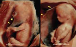 Опасность амниотического тяжа в полости матки при беременности