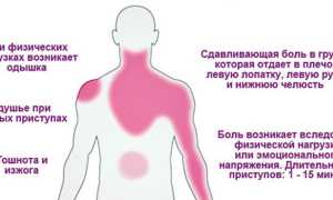 Нестабильная стенокардия — лечение и клинические рекомендации