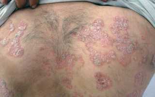 Король кожи — самая эффективная мазь от псориаза