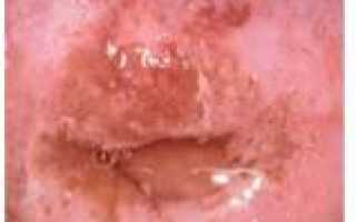 Метаплазия шейки матки: причины, симптомы, лечение и прогноз