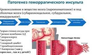 Основные причины возникновения инсульта у взрослых и детей