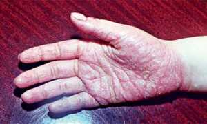 Что такое ладонно-подошвенный псориаз?