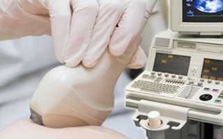 Лактостаз у кормящей мамы