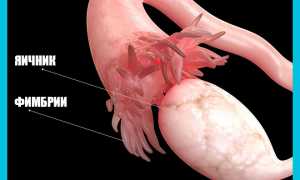 Действительно ли можно забеременеть при гидросальпинксе