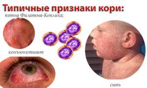 Прививка от кори взрослым и детям: инструкция и календарь вакцинации