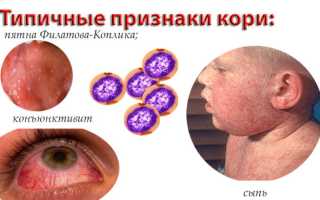 Прививка от кори взрослым и детям: инструкция и календарь вакцинации