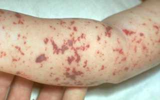 Вакцина Менактра: инструкция, где купить и сделать, цены, отзывы