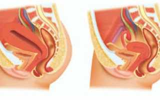 Особенности протекания процесса инволюции матки