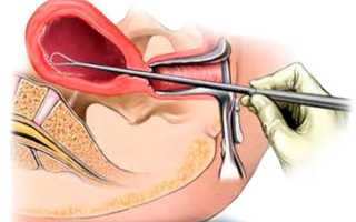 Как проходит восстановление после чистки матки?