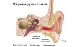 Последствия отита у взрослых — причины развития и список осложнений