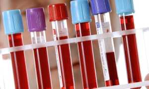 Лейкоплакия — причины возникновения у детей и взрослых, диагностика, локализация и методы лечения