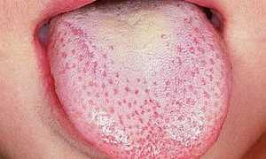 Флюкостат от молочницы: инструкция, цена, аналоги, отзывы