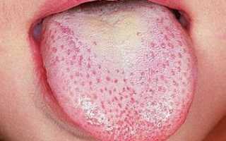 Флюкостат от молочницы: инструкция, цена, аналоги, отзывы