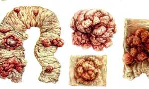 Тубулярная аденома — виды, причины, симптомы и удаление