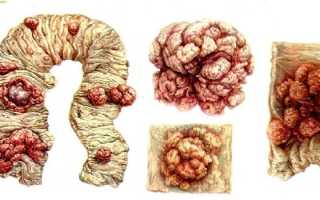 Тубулярная аденома — виды, причины, симптомы и удаление