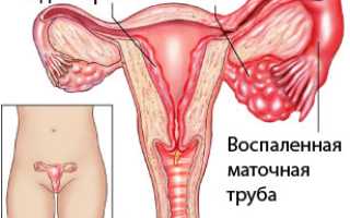 Односторонний аднексит: причины, симптомы, диагностика и лечение