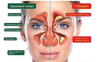 Чем опасен гайморит при беременности для плода и матери?