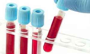 Клебсиелла – что это такое и пути передачи бактерии, симптомы, диагностика, лечение и профилактика