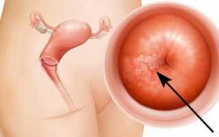 Возможные осложнения после прижигания лейкоплакии шейки матки