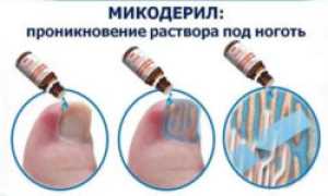 Жидкие формы средств против грибковой инфекции