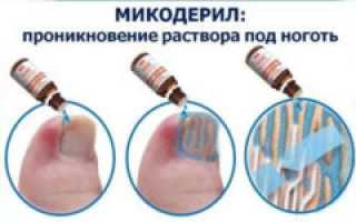 Жидкие формы средств против грибковой инфекции