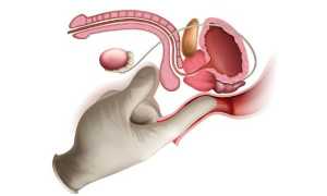 Лечение аденомы предстательной железы в домашних условиях — медикаменты и народные средства