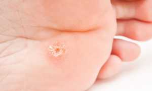 Шипица на ноге — симптомы и причины появления, профилактика, способы удаления и последствия