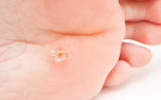 Шипица на ноге — симптомы и причины появления, профилактика, способы удаления и последствия