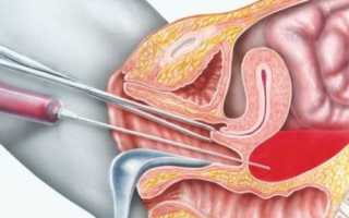 Пункция матки: диагностическая ценность и порядок проведения