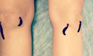 Гонартроз коленного сустава — причины и степени заболевания, лечение